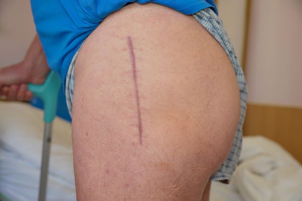 Hip Replacement Surgery