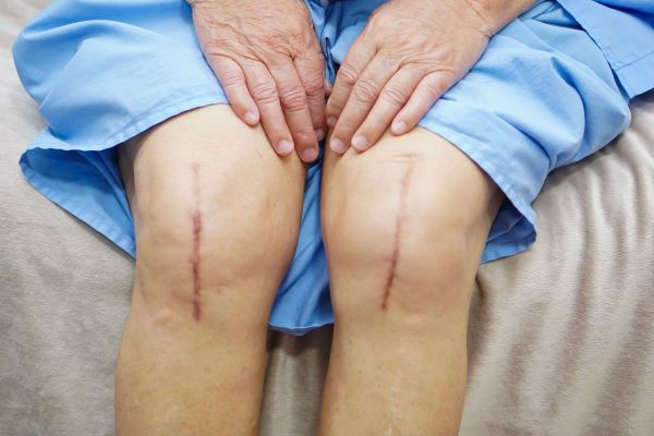 Knee-replacement-surgery